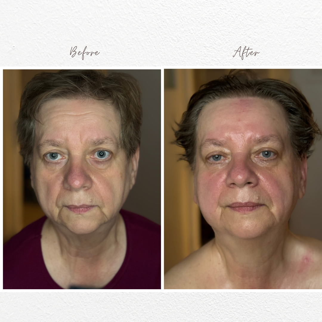 Before and after results - Natural face lifting transformation